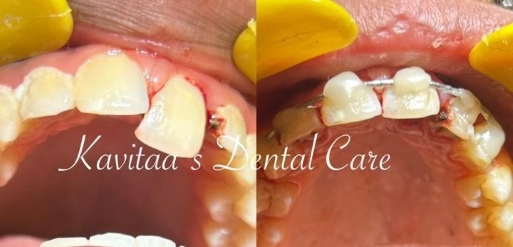Dental trauma management treatment before and after